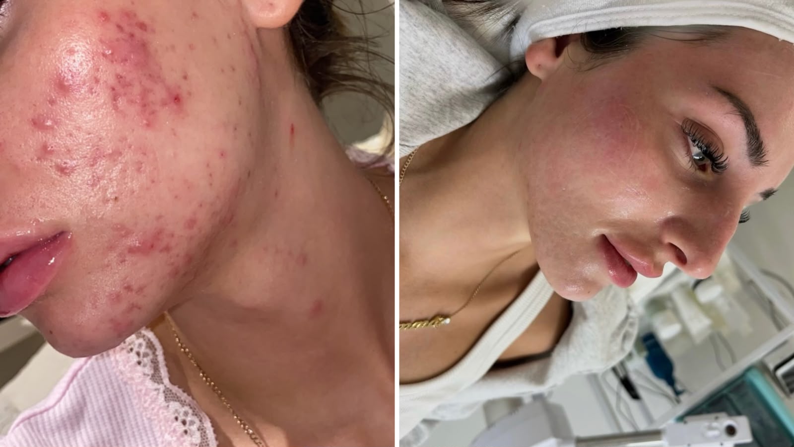 Congested, inflamed skin before and during in-clinic acne care at Derma Corner Parramatta